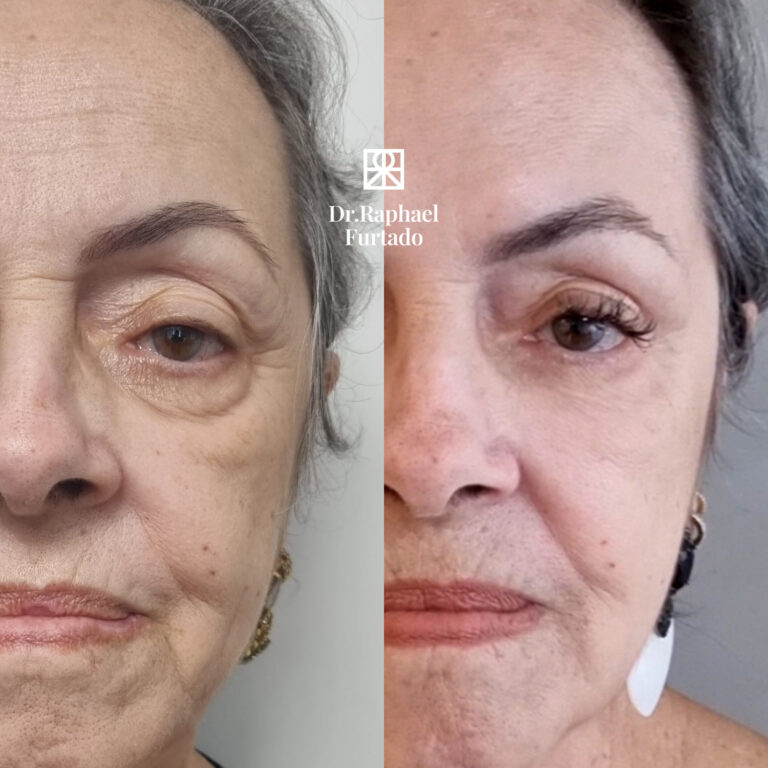 Olheiras com fios lisos de pdo copy